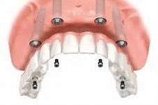 multiple implant denture
