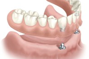 lower implant denture